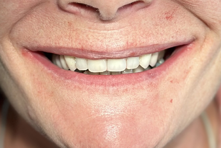 A close up of the teeth and smile of a person