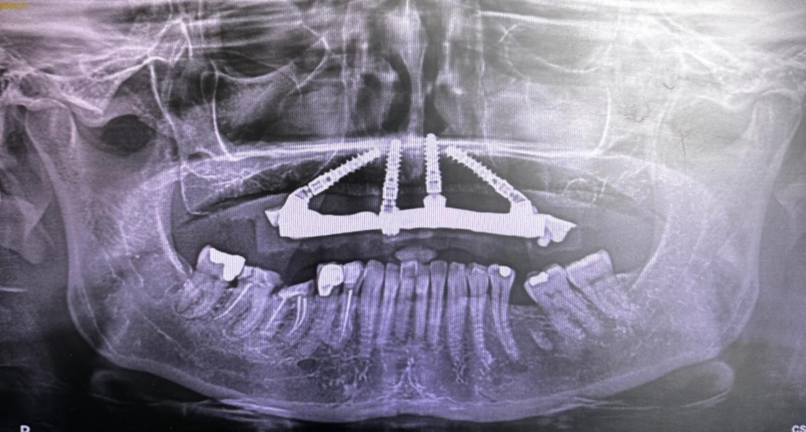 A x-ray of the ribs and lower portion of the abdomen.