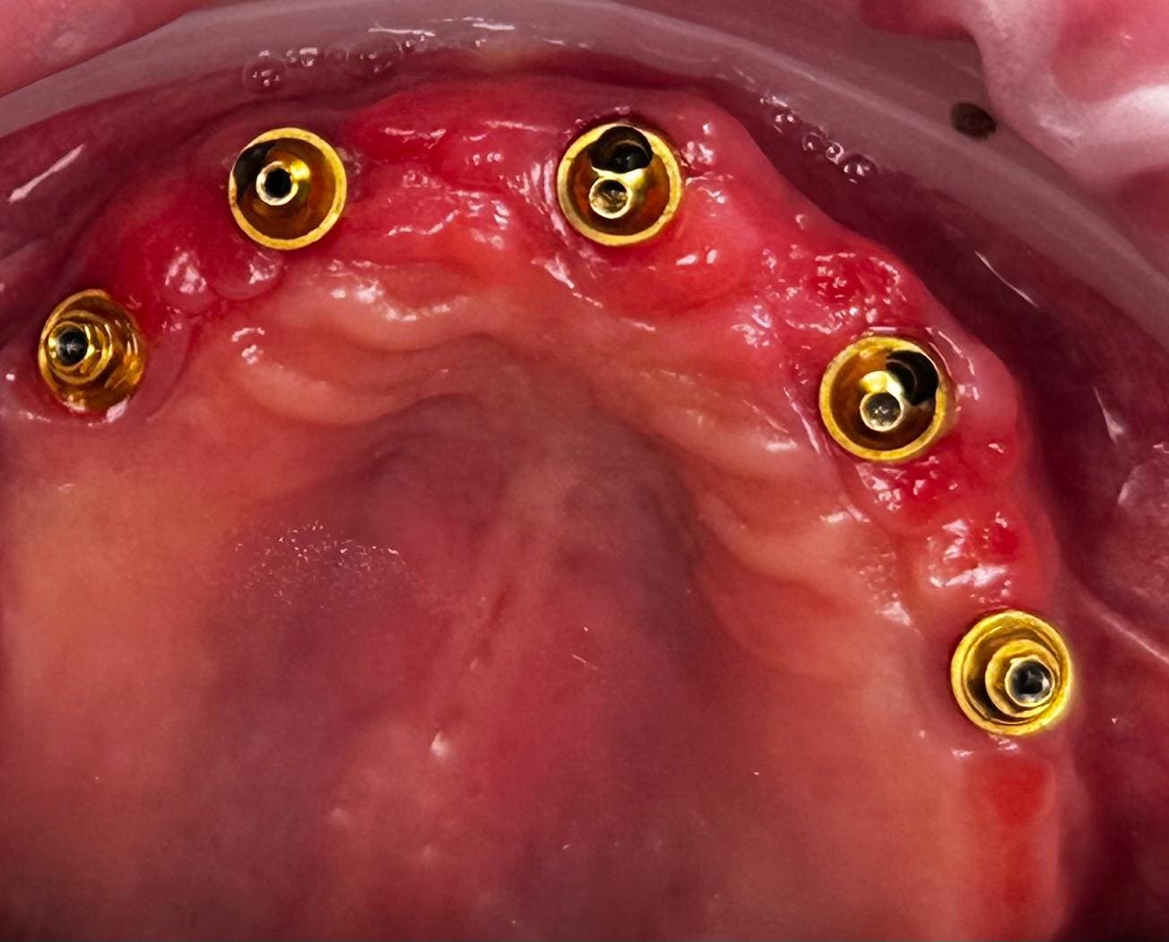 A close up of the inside of an implant